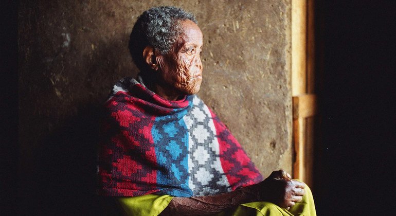 埃塞俄比亚首都亚的斯亚贝巴的一名麻风患者。